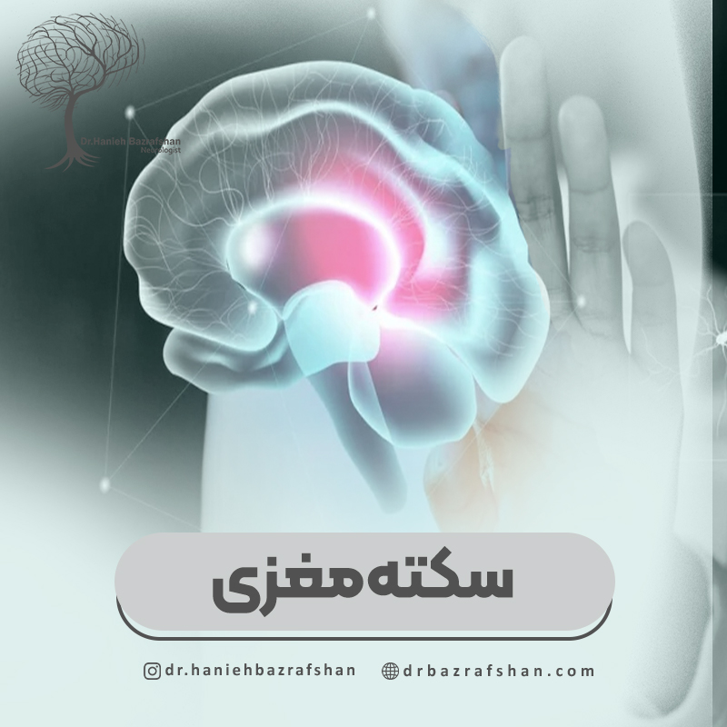 سکته مغزی