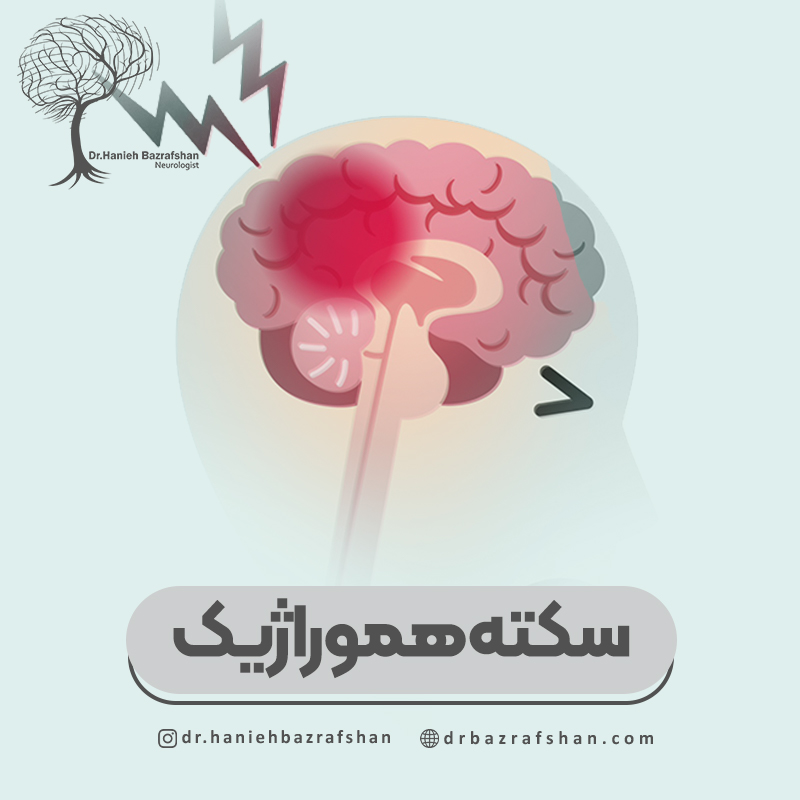 سکته مغزی هموراژیک (Hemorrhagic Stroke)